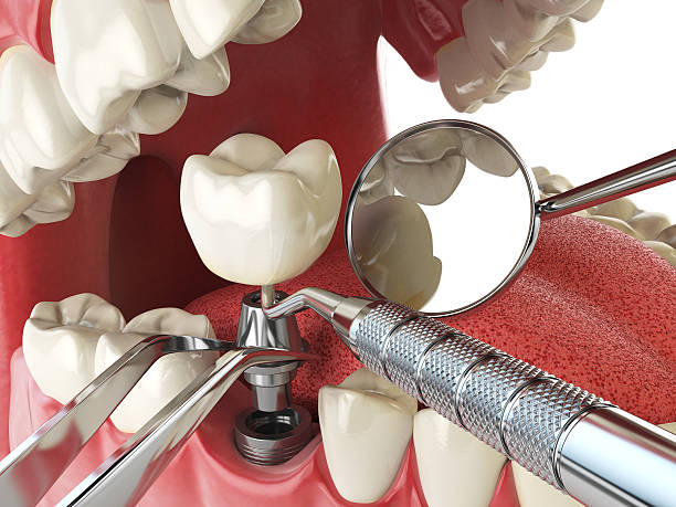 Best Root Canal Emergency Dentist  in Schoolcraft, MI